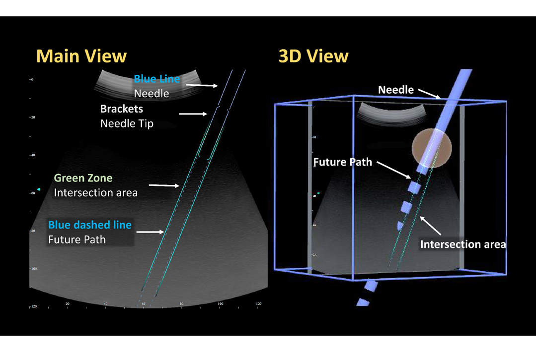 NAVIRFA®needle path 3d view