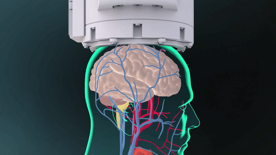 TECHNOLOGY 2 NaviFUS® Neuronavigator-guided transcranial focused ultrasound system