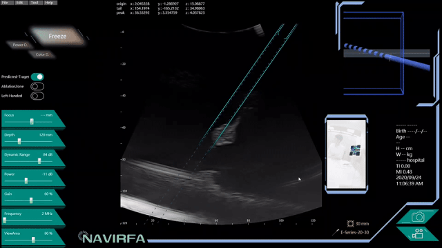 TECHNOLOGY 3 NAVIRFA® Needle Tracking System