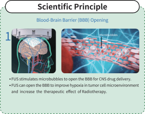 Blood-Brain-Barrier (BBB) Opening