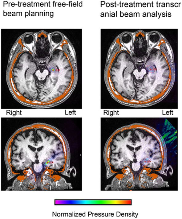 NaviFUS Clinical Trial Published in Epilepsia 2 image 2